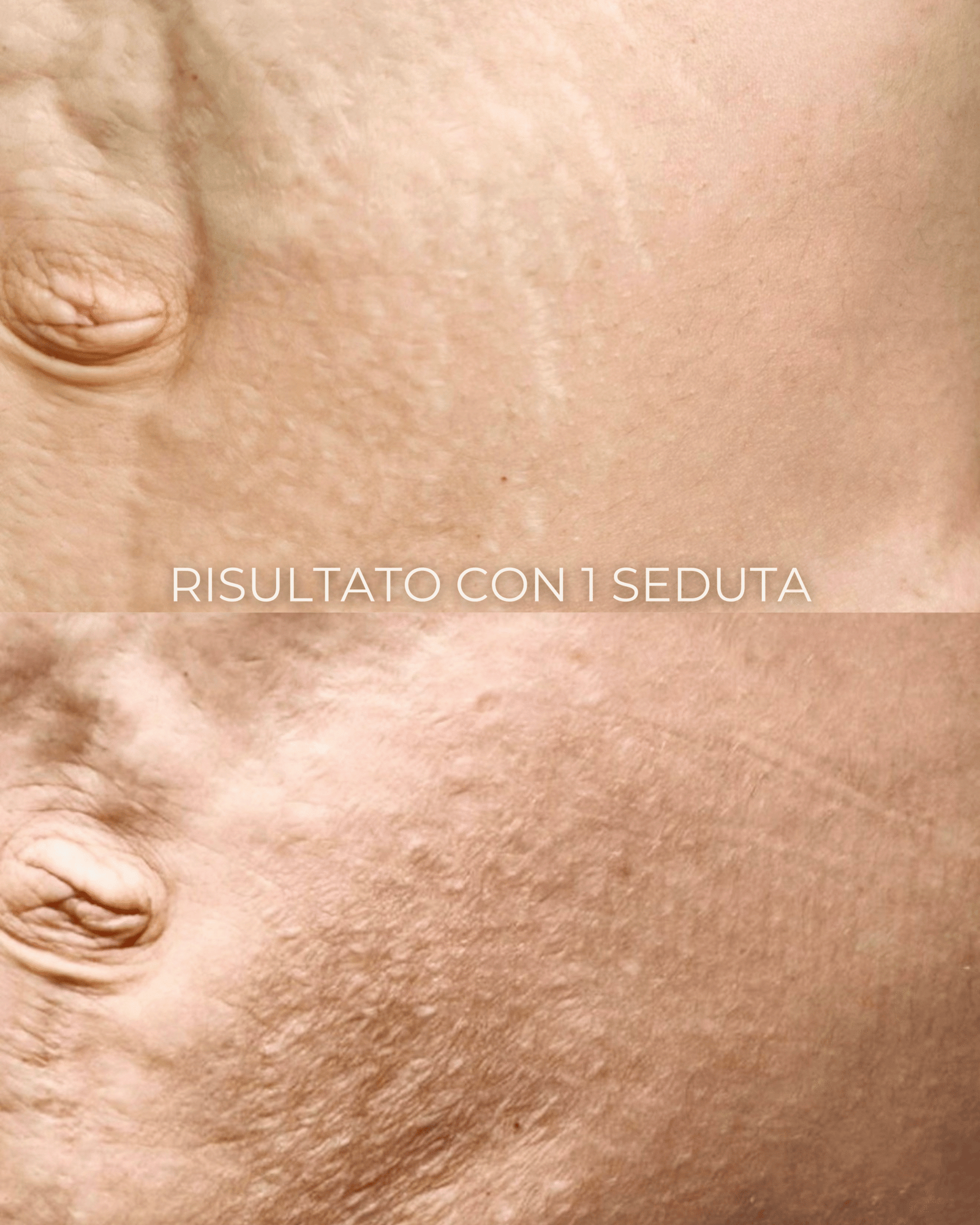prima e dopo trattamento microderma
