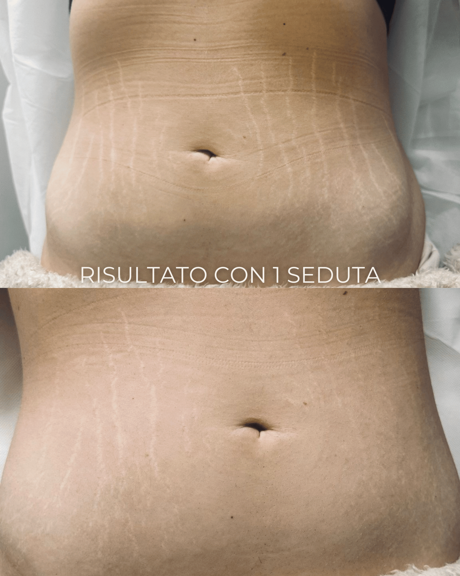 Prima e dopo trattamento smagliature Tratti e Linea