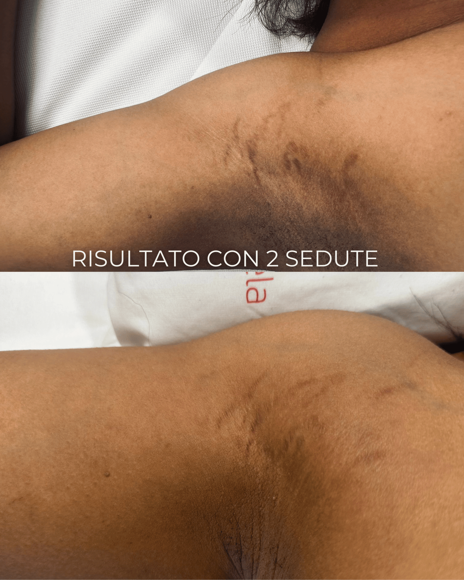 Prima e dopo trattamento smagliature Tratti e Linea