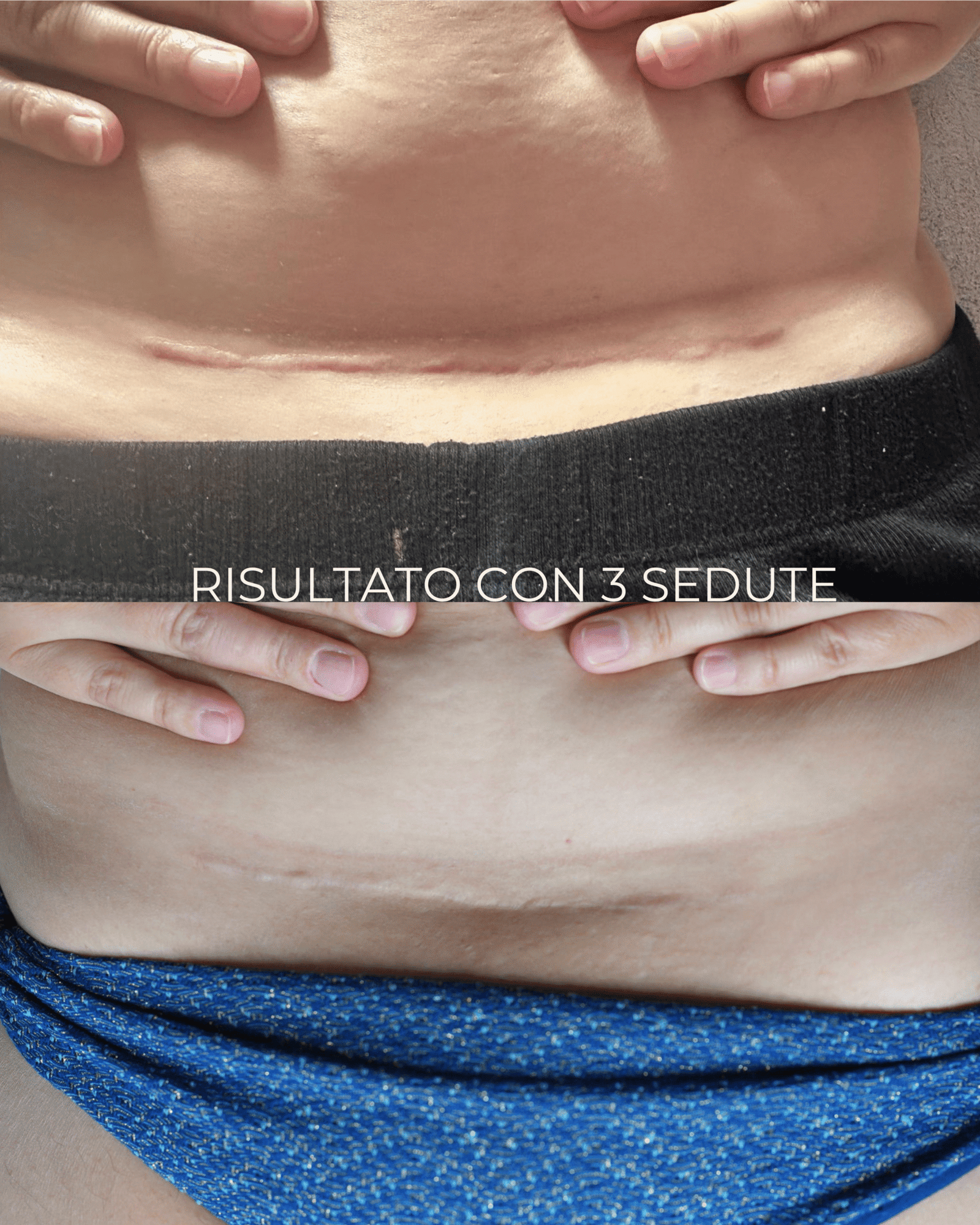 Prima e dopo trattamento smagliature Tratti e Linea