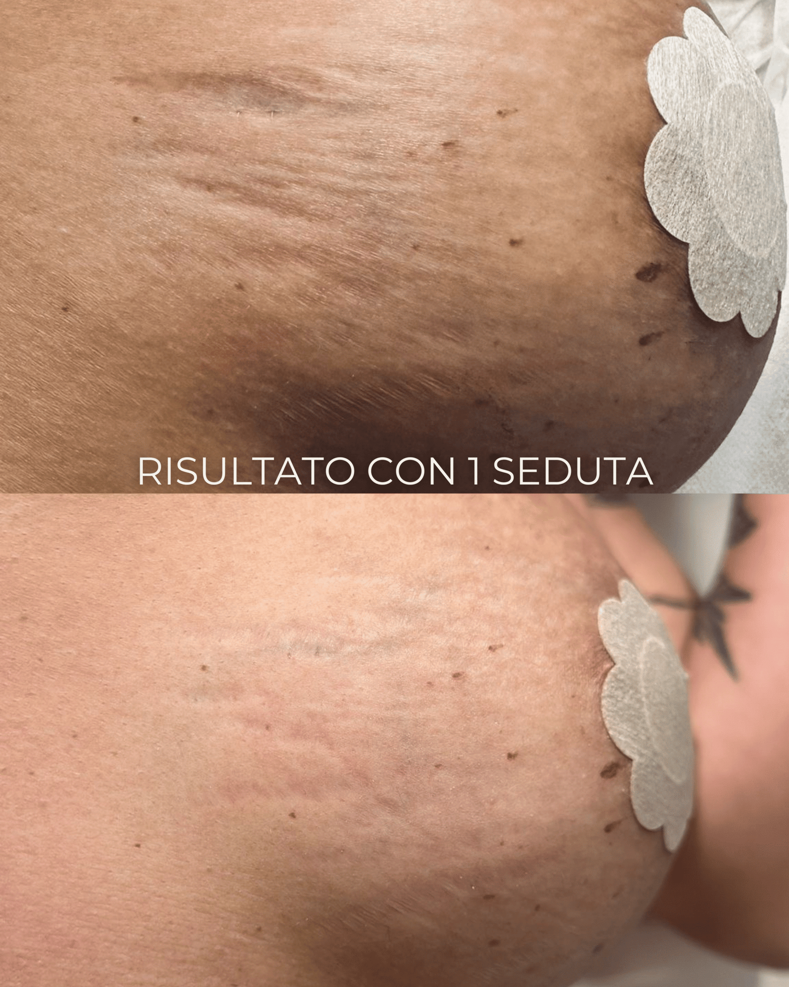 Prima e dopo trattamento smagliature Tratti e Linea